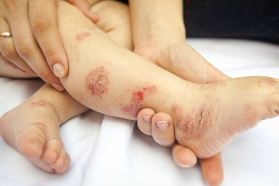 Use Of Topical Steroids With Eczema Red Skin Syndrome